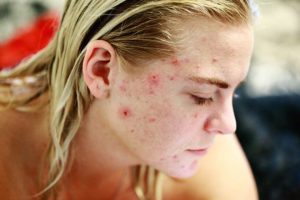 face blemishes problem