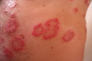 scaly skin rash