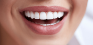 dental veneers